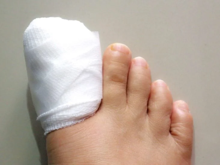 Toenail Regrowth Tends To Be Slower After An Injury Or Trauma High-Res  Stock Photo - Getty Images