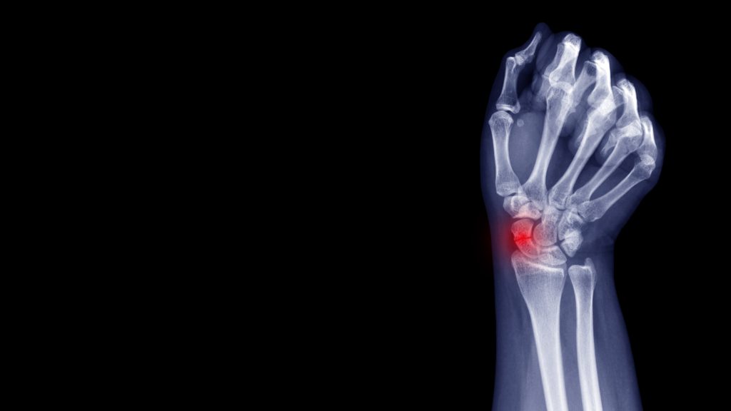 wrist fracture, Veda Medical