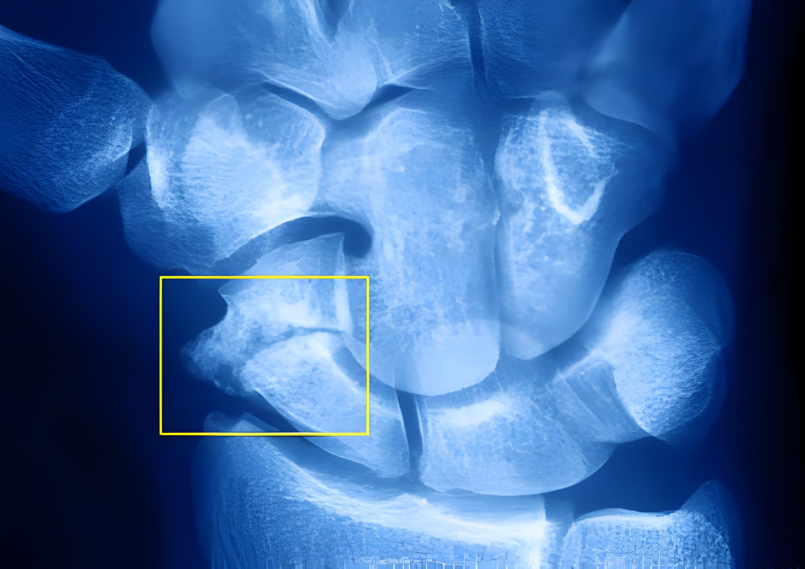 How Serious is a Scaphoid Fracture?