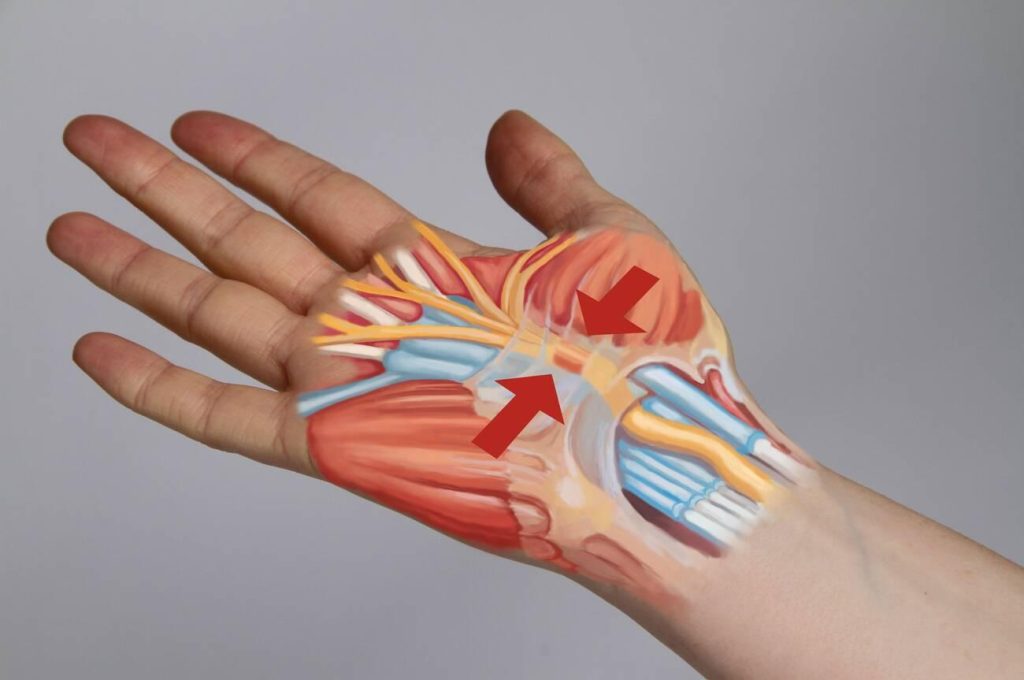 Carpal Boss vs Carpal Tunnel: Understanding the Differences