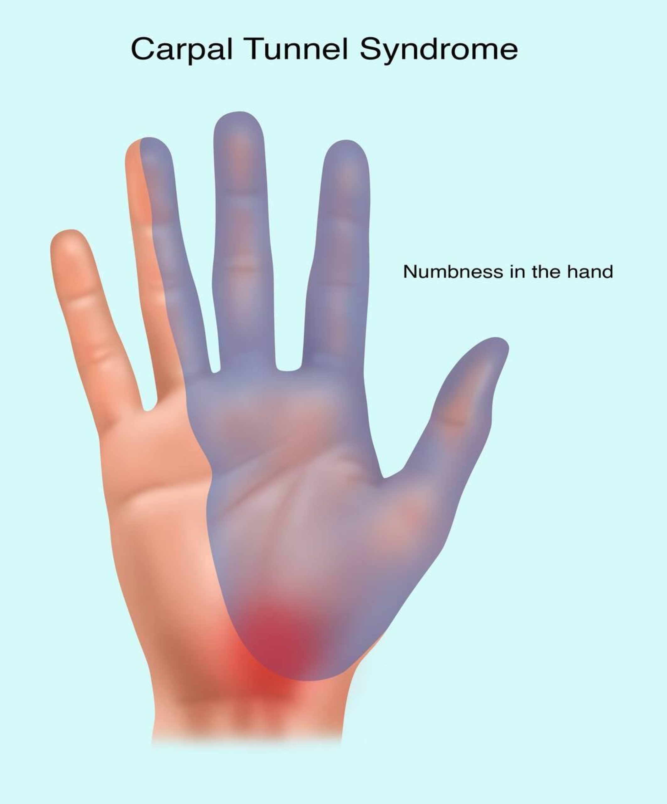 Carpal Boss vs Carpal Tunnel: Understanding the Differences