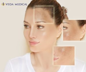 Chemical peels in San Antonio TX