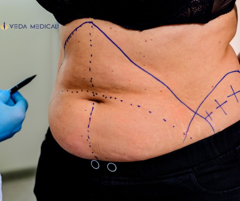 Tummy tuck surgery in San Antonio TX