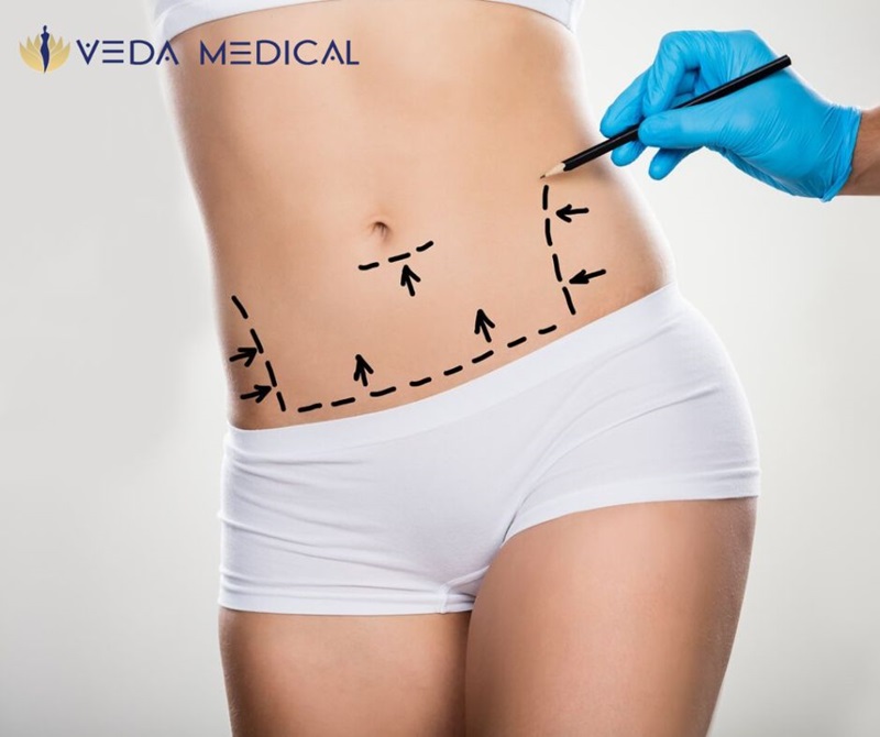 Tummy tuck surgery San Antonio TX